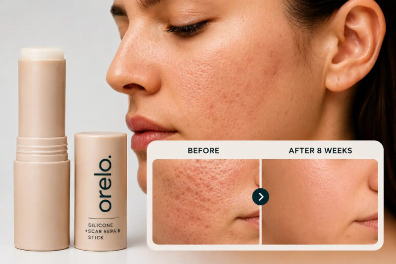 Orello silicone scar repair stick with 'before' and 'after' skin comparison on a woman's face.